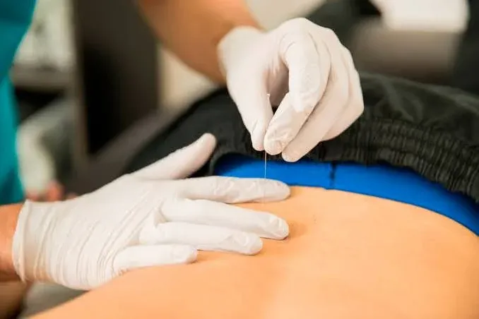Dry Needling im unteren Rücken – Behandlung eines Triggerpunkts in der Lendenmuskulatur