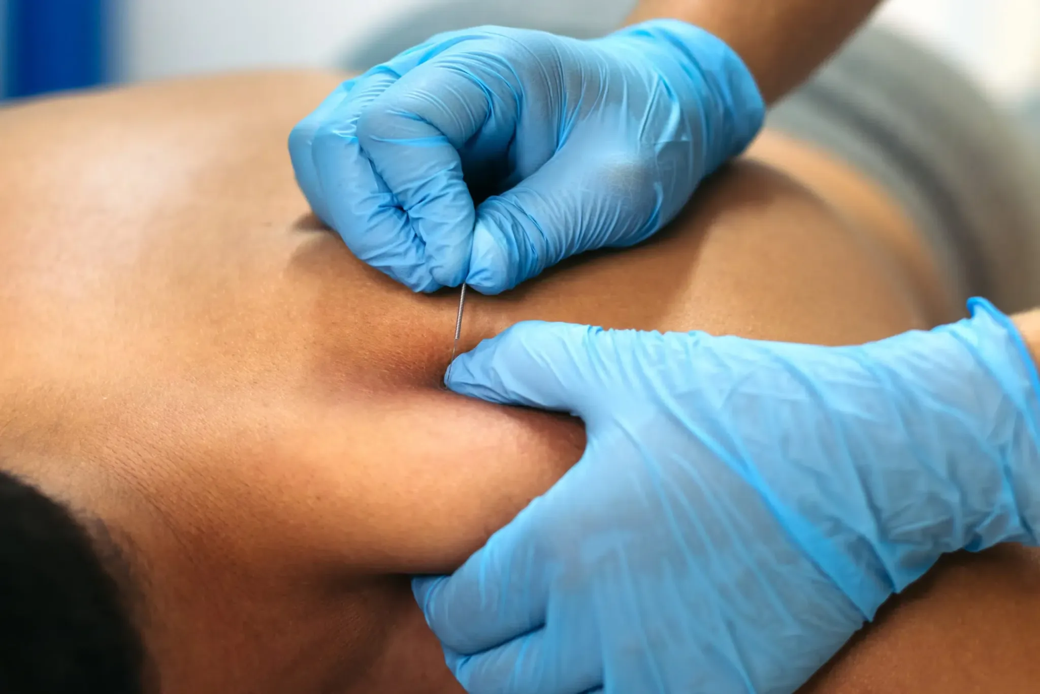 Dry Needling an der Schulter-Nacken-Muskulatur mit sterilen Einmalnadeln und Handschuhen